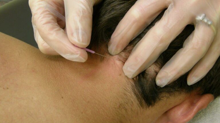 Dry needling on the back of the neck